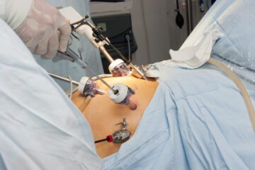 Magenbypassoperation – Kostenerstattung bei Adipositas