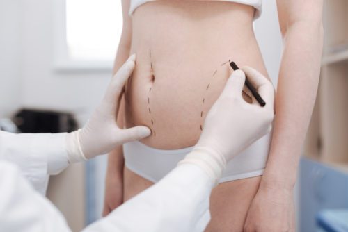 Krankenversicherung - Genehmigungsfiktion für eine Liposuktion