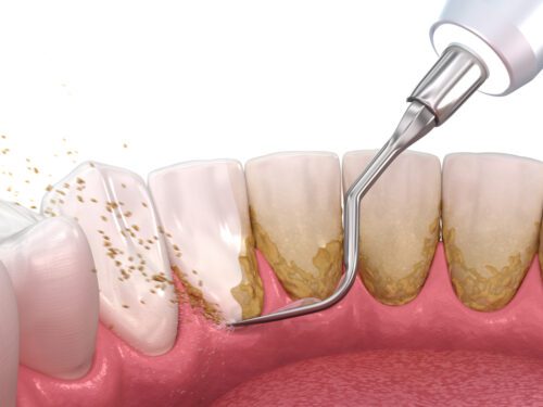 Parodontitis - Durchführung professionelle Zahnreinigung