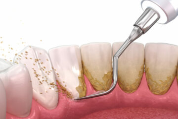 Parodontitis – Durchführung professionelle Zahnreinigung