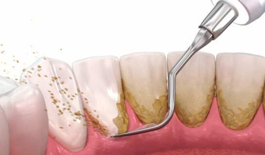 Parodontitis – Durchführung professionelle Zahnreinigung