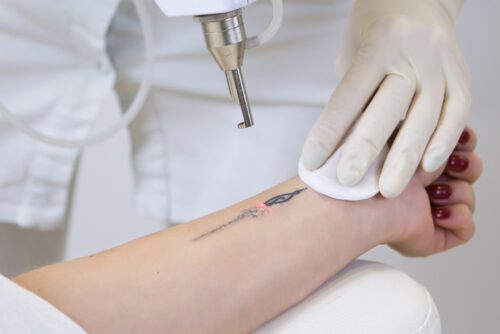 Anspruch Kostenübernahme für Tattoo-Entfernung gegenüber Krankenversicherung